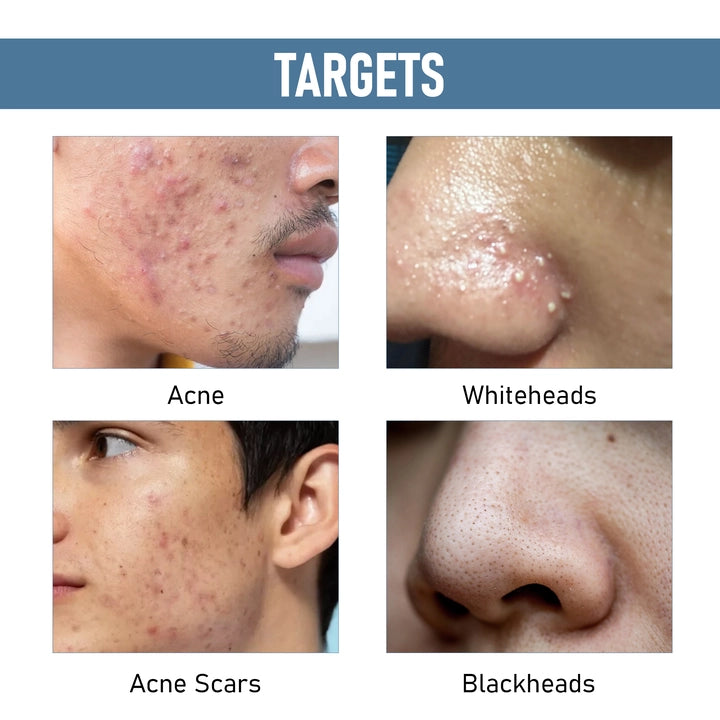 Anti Acne & Spots Reduction Face Wash